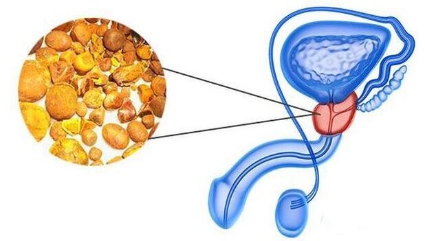 Calcinates in the prostate gland