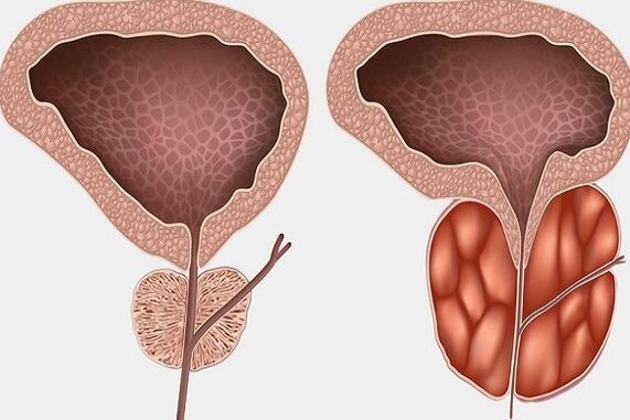 Prostate inflammation