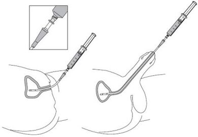 Instillation of a drug solution in urethra