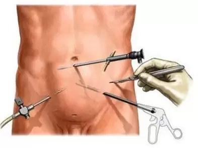 surgical treatment of chronic prostatitis