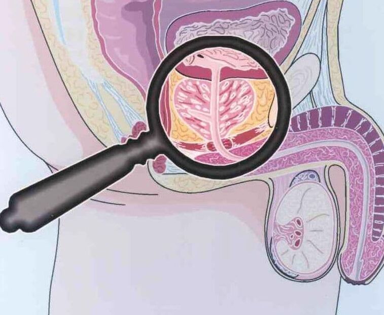 Lesions of prostate tissue in men with chronic prostatitis